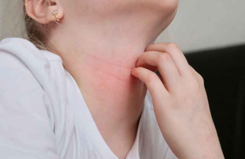 Plaque rouge sur le cou avec démangeaisons : causes et traitements-Green Bear Coffee