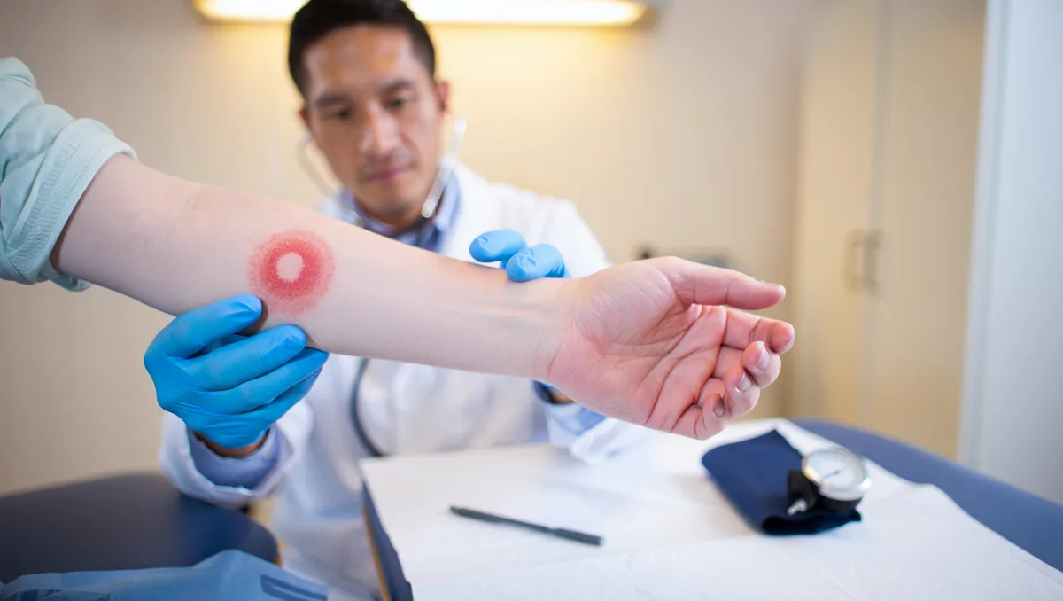 Pourquoi la borréliose échappe si souvent au diagnostic — La maladie de Lyme peut toucher plusieurs organes et se manifester par des signes très différents, ce qui complique son repérage. Chez certains, la première trace est un érythème migrant , une